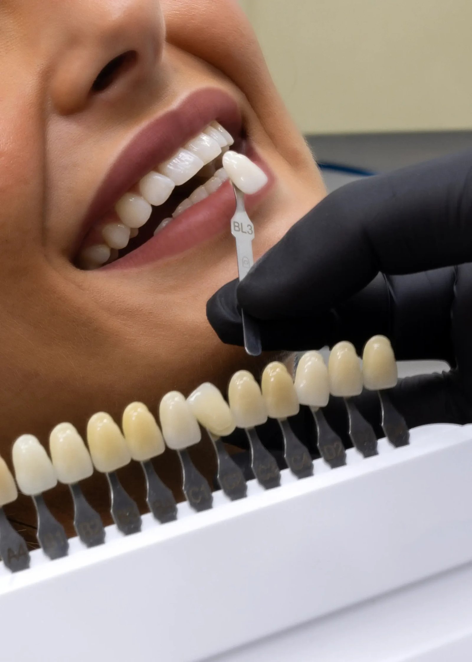 Porcelain-Ceramic-Veneers-scaled.webp