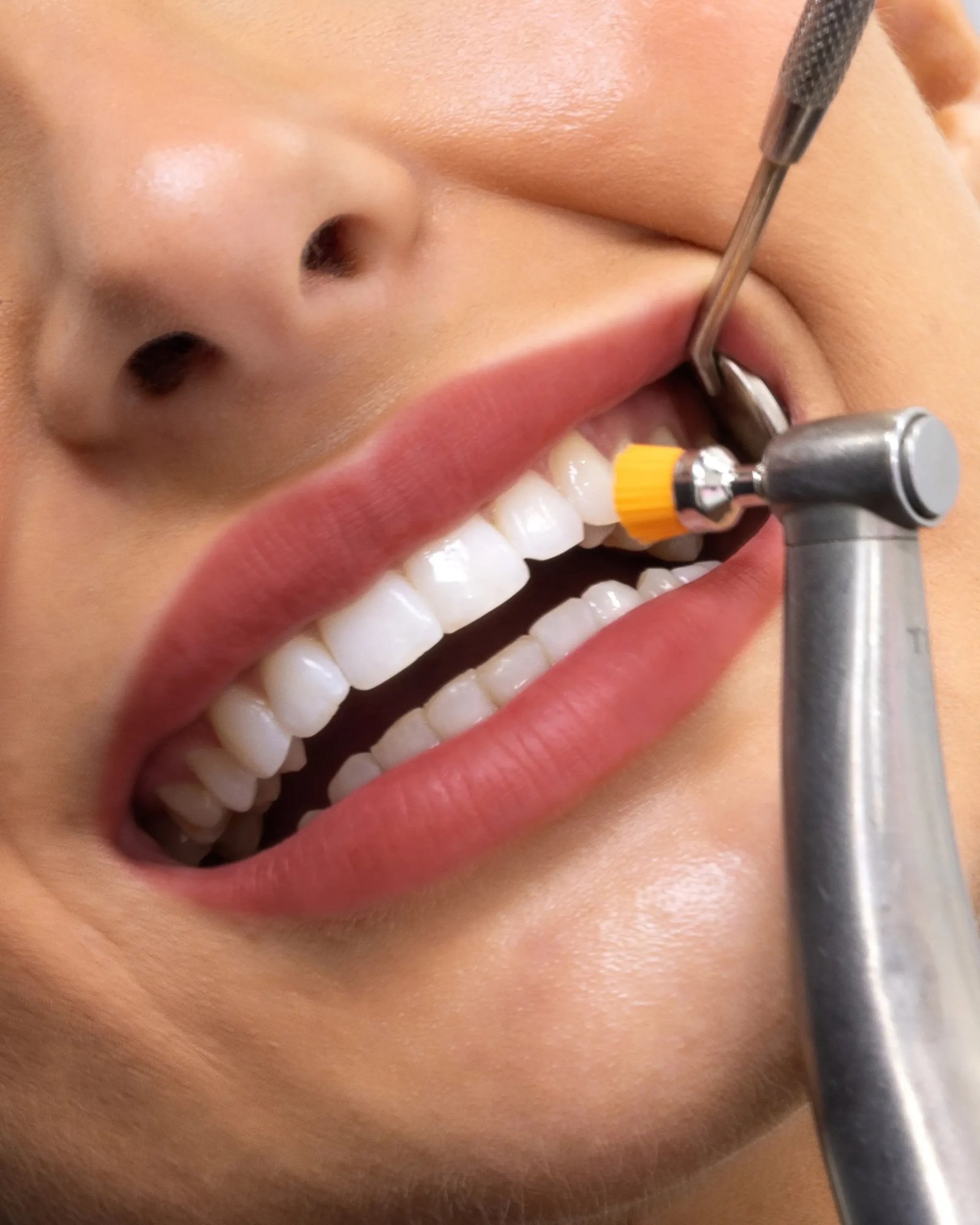 teeth-cleansing-scaled