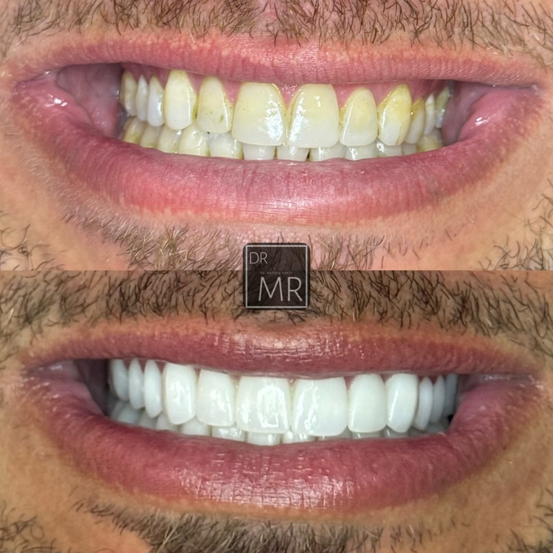tooth-whitening.png