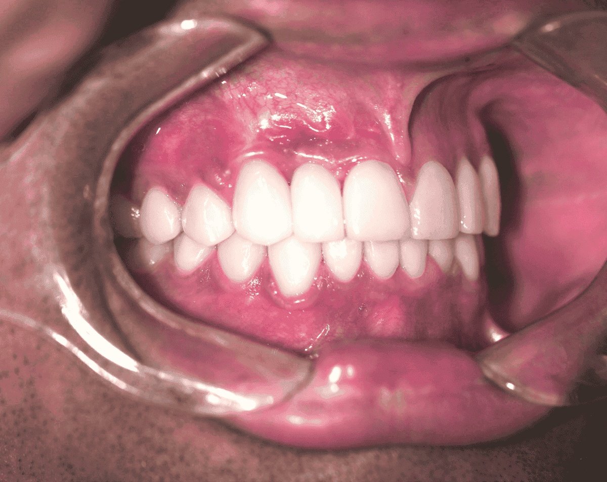 images/uploaded/images/after-dental-implants-1-1.png