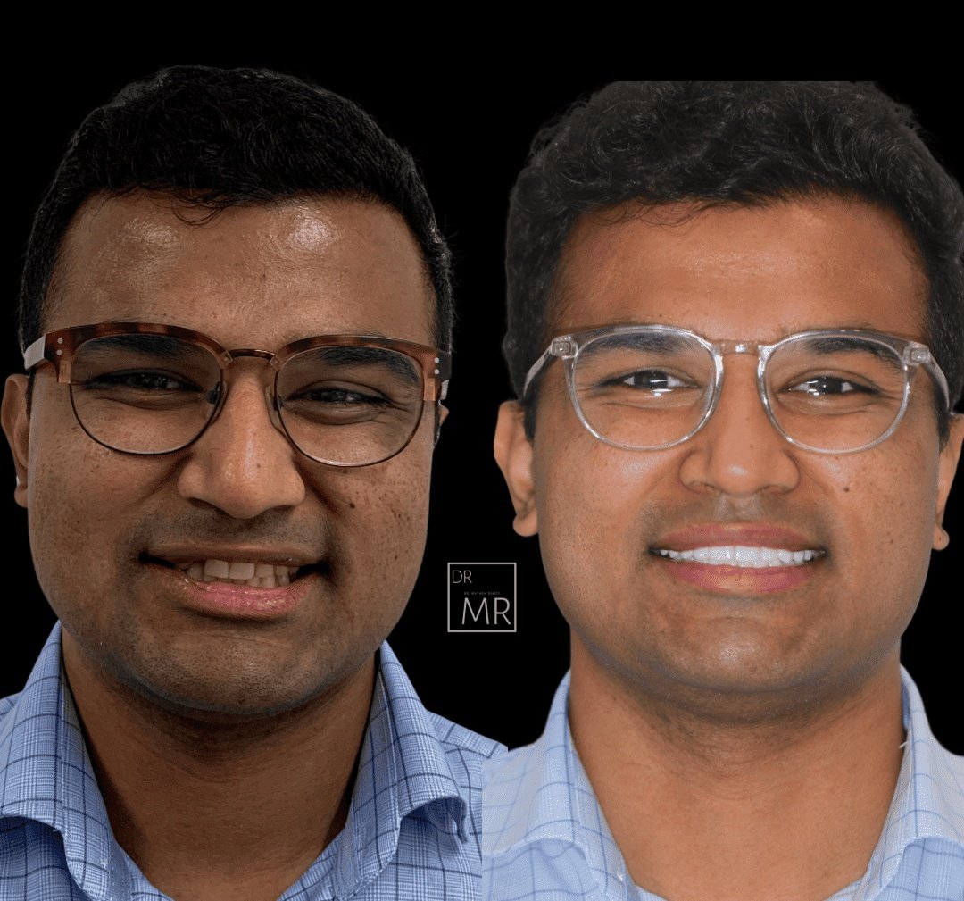 teeth-whitening