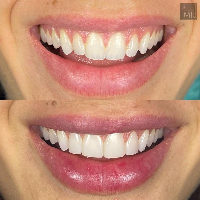 veneers.jpeg